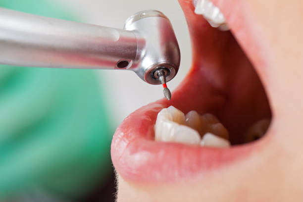 Best Lost Filling or Crown Replacement in Winston Salem, NC